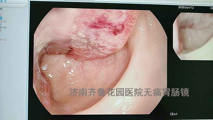 诊断：直肠占位