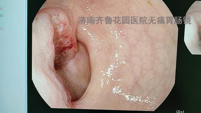 诊断：直肠占位