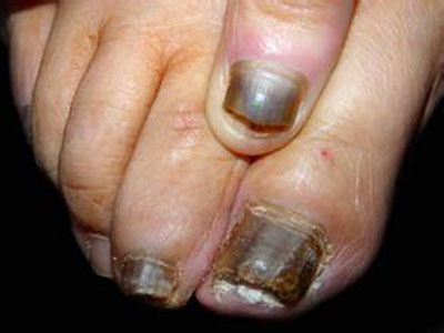 患上灰指甲会有哪些症状表现