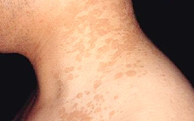 在身体容易出汗的部位,花斑癣主要是受到真菌感染而引起的一种皮肤病