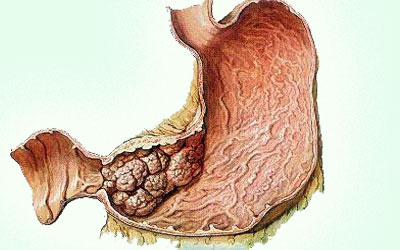 胃癌为何会屡屡危害人们身体健康