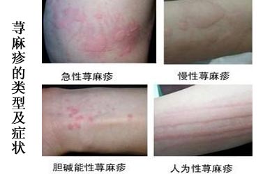2014-12-27 16:11 济南齐鲁花园医院 皮肤科    荨麻疹是一种比较