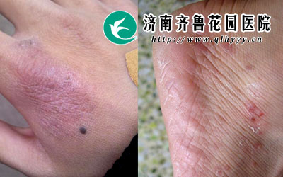 手足癣是很常见的一种皮肤类疾病,手足癣的发病率很高,而且还具有很强