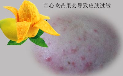 过敏性皮肤的人当心吃芒果会导致皮肤过敏