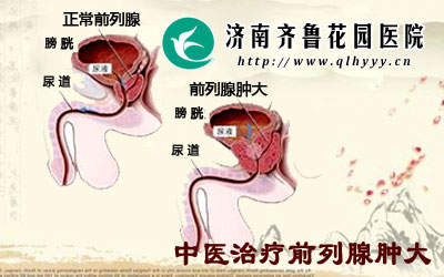 哪种方法治疗前列腺肿大效果好