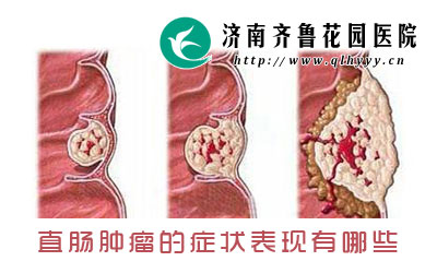 直肠肿瘤的症状表现有哪些