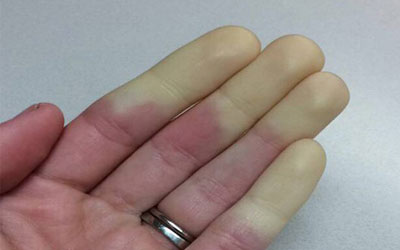 雷诺综合症患者发病时手指会先变苍白而后发紫