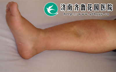 下肢水肿是慢性肾炎的临床表现