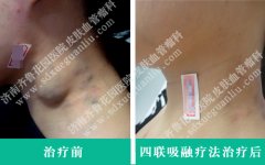 胎记之痕，一部关于脖子上的故事，胎记之痕，脖子上的故事