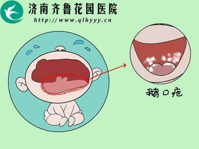 宝宝嘴里有白色斑是鹅口疮吗 应该如何治疗
