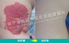 治疗孩子腿上的红色斑片大概需要花多少钱