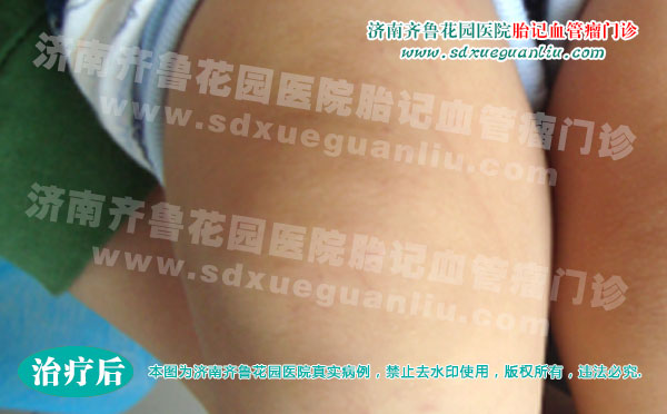 孩子膝盖关节处长血管瘤会影响后期学走路吗
