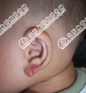 孩子耳朵垂上的草莓状血管瘤是一种什么病