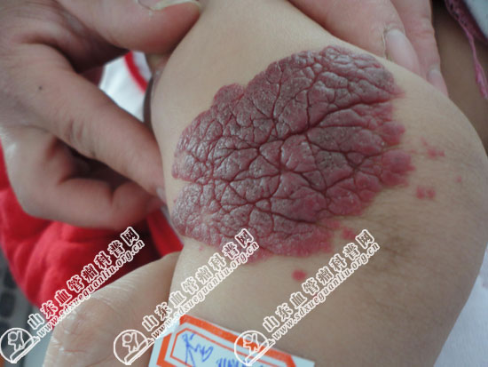 宝宝草莓状血管瘤长在孩子腿上严重吗